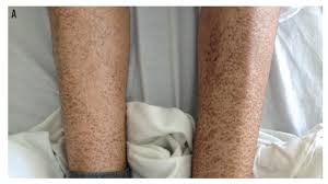 Image result for Ichthyosis