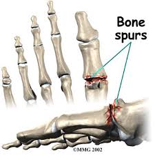 Pin On Bone Spurs