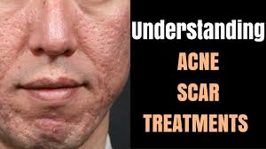 Sebelum lanjut lagi, beginilah keadaan mukaku yang super parah bopengnya sebelum treatment. Acne Scars Before And After By Dr Davin Lim Lasers Lifts