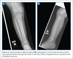 Twisting injuries produce the more common spiral fracture. Four Fracture Patterns Unique To Pediatric Patients Mdedge Emergency Medicine