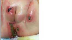 Image result for diaper dermatitis
