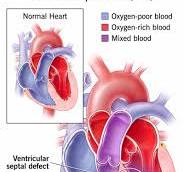 Ventricular Septal Defect (VSD): Types & Causes