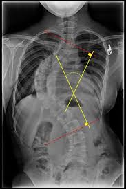 Cobb Angle Radiology Reference Article Radiopaedia Org Radiology Radiology Student Medical Imaging