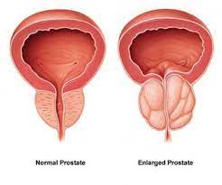 But they have identified several factors that raise a man's risk of the disease. Bph Enlarged Prostate San Antonio Experts At Urology San Antonio