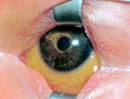 Ophthalmic Pseudomonas Infection In Infancy Adc Fetal Neonatal Edition