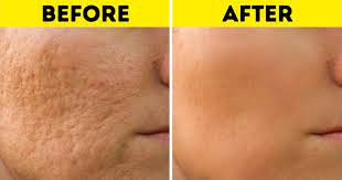 10 Hacks To Remove All Types Of Scars And Help Them Heal