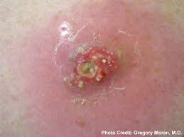 These include methicillin and related antibiotics, such as penicillin, vancomycin. Mrsa Bacteria Photo 9 Mrsa Cdc