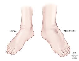 Edema Causes Symptoms Treatment