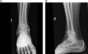 Image result for Tibia Stress Fracture
