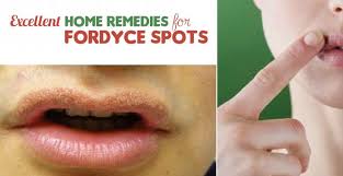 Oct 13, 2018 · sebum on the skin: Check Out The Home Remedies For Fordyce Spots That Will Help You Get Rid Of Those Annoying Fordyce Spots Effectively In 2021 Fordyce Small Bumps On Lips Lips Remedies