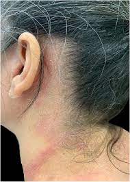 Allergic Contact Dermatitis By Shampoo Components A Descriptive Analysis Of 20 Cases