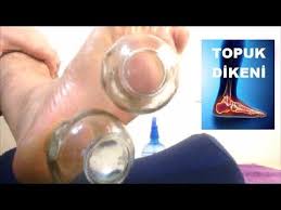 Dr Aidin Salih In Tavsiyesi Kuru Kupa Teknigi Ile Topuk Dikeni Terapisi Dry Cupping For Heel Spur Yo 2020 Topuk Dikeni Dogal Tedaviler Evde Hazirlabilen Ilaclar