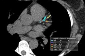 Ct Calcium Scoring Becoming A Key Risk Factor Assessment Daic