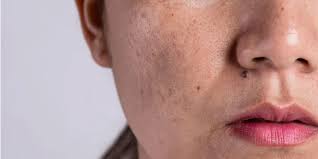 Skin Pigmentation Treatment in Dubai | Euromed® Clinic