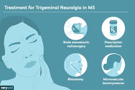 Recommended diagnostic criteria for multiple sclerosis: Trigeminal Neuralgia In Ms Symptoms Diagnosis Treatment