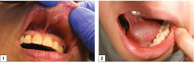 In fact, treating most burns inside your mouth is relatively simple. Racgp Common Causes Of Swelling In The Oral Cavity