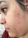 curare cicatrici acne