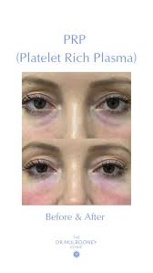 PRP involves taking a small vial of blood from a patient’s arm, spinning  the blood in a centrifuge to separate the red blood cells from the golden  coloured platelet rich plasma. The nutrient rich, ...