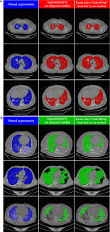 Quantitative ct analysis of lung parenchyma. Segmentation Of Lung Parenchyma In Ct Images Using Cnn Trained With The Clustering Algorithm Generated Dataset Biomedical Engineering Online Full Text