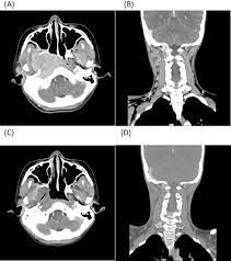 When you breathe, air flows through your nose into your throat and nasopharynx, and eventually into. Advanced Nasopharyngeal Carcinoma In Children Sciencedirect