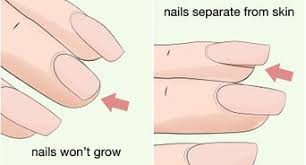 How can i stop myself from chewing my nails or my cuticles? 6 Ways To Stop Biting Your Nails Wikihow