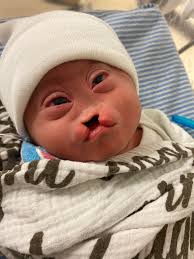 What is the maximum age of your children with alobar holoprencephaly? my  daughter only lived 7 months