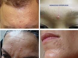 There are a few families where multiple lesions begin to occur during puberty. Don T Panic It S Only Sebaceous Hyperplasia No Body Problems Skin Bumps On Face Skin Bumps Pimples On Face