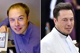 Do you have to wear hair products during surgery? It S Highly Likely Elon Musk Spent Over 20k On Hair Transplant Surgery Doctor Says