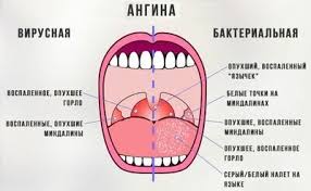 Streptokokk Infekciya Chto Gde Kogda Chto Delat Poleznye Sovety Dlya Zhizni Yandeks Dzen