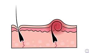 If a doctor diagnoses it, they may call it an epidermoid cyst or a pilonidal cyst. Essential Oils For Ingrown Hairs With Recipes Simple Living Creative Learning