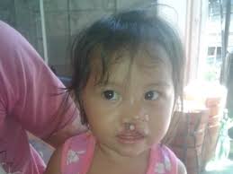 Success! Sabrina from the Philippines raised $69 to fund a cleft lip and  palate repair.