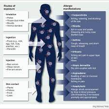 Allergy Is A Systemic Disease In The Immune System Sensitization Can Download Scientific Diagram
