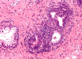 Image result for Acute Bacterial Prostatitis