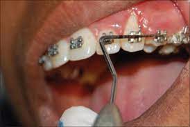 We did not find results for: What Is Fiberotomy Westermeier Martin Dental Care