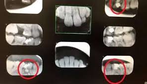 Because of the sedation and anesthetic, getting a crown is not painful. Tooth Hurts After Crown Why Does Tooth Hurt After Crown Bauer Smiles