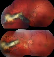Pseudophakic retinal detachment after uneventful phacoemulsification and subsequent neodymium: Vitrectomy The American Society Of Retina Specialists
