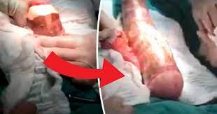 WATCH: 18ins homemade sex toy surgically removed from man's anus - Daily  Star