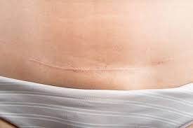 Parto Por Cesarea Como Recuperarse Mas Rapido En El Postparto Vida Equilibrada Exercicios Pos Parto Cinta Pos Parto Parto Cesaria