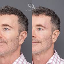 Temple Filler Brisbane