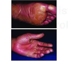 3 425 просмотров • 21 мая 2020 г. Pityriasis Rubra Pilaris Download Scientific Diagram