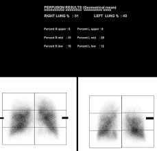 Image result for Ventilation Perfusion Scan