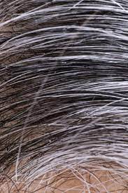 If it does not appear to be related to aging, medical attention may be. White Hair Causes And Ways To Prevent It