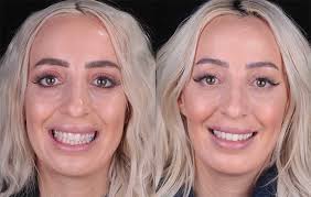 In the cosmetic surgery industry, this is referred to as a gummy smile. there is a variety of reasons for a gummy smile. Gummy Smile Treatment Implant Perio Center