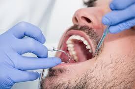 When it comes to protect or maintain your oral health, clove is the best ingredient that fights the microbes in your mouth that lead to tartar. Why You Shouldn T Try To Remove Plaque By Yourself Dr John Michaels