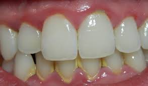 Avycolwhitexpert Ubat Putihkan Gigi
