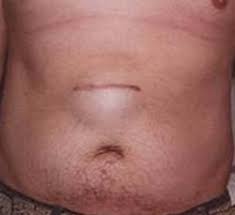 Check spelling or type a new query. Incisional And Ventral Hernia Laparoscopyindia Com Laparoscopic And Thoracoscopic Surgery
