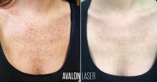 Maybe you would like to learn more about one of these? Ipl Laser To Get Rid Of Sun Damage Sunspots Age Spots Hyperpigmentation And Broken Capillaries On The Ches Aging Signs Broken Capillaries Hyperpigmentation