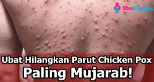 We did not find results for: Hilangkan Parut Chicken Pox Yang Hodoh Dengan Cepat