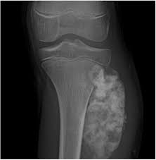Image result for Osteosarcoma