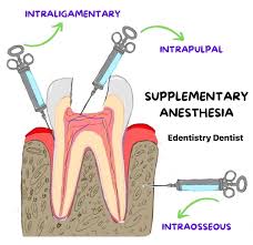 Image result for Intrapleural Anesthesia